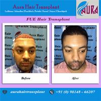 Aura Hair Transplant Ludhiana image 1